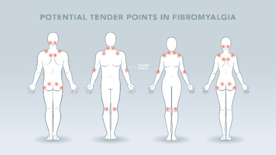 Fibromyalgie se může projevit bolestí svalstva kdekoliv na těle, stejně tak ale může působit například zažívají obtíže či migrény